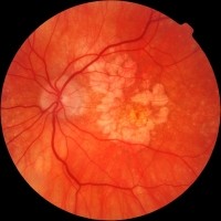 Болезни глаз могут быть предиктором деменции
