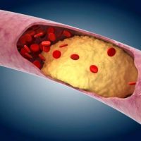 Атеросклеротические бляшки приводят к развитию болезней печени