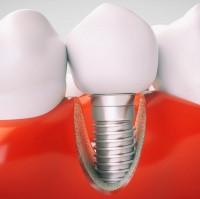 Новая технология предотвращает отторжение зубных имплантов